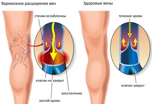 Симптомы развития варикозного расширения вен